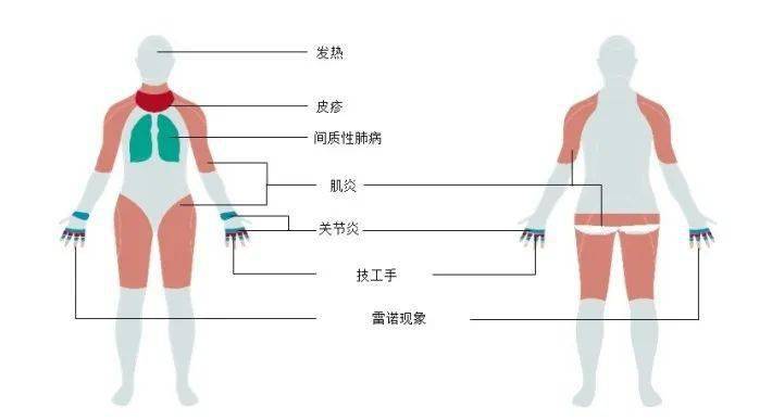 特发性炎性肌病 分类