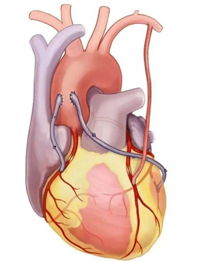 健康小课堂什么是冠状动脉搭桥术