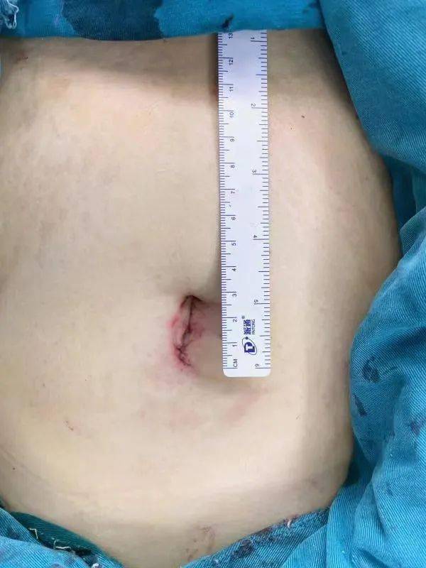 子宫切除手术伤口图片图片