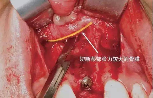 图解口腔种植翻瓣术切开步骤