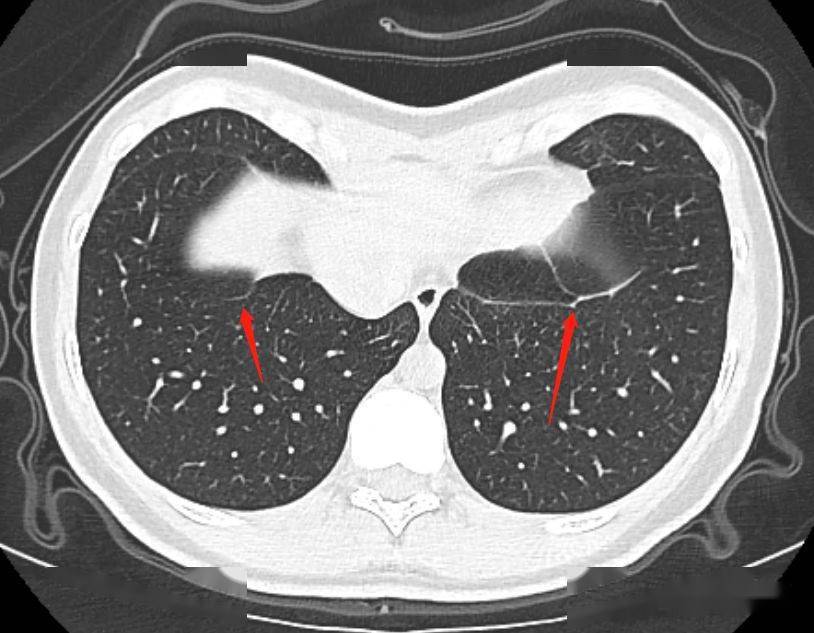 胸部ct上的肺韧带别再报纤维条索了