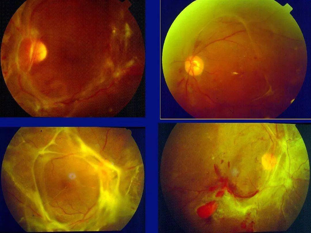 糖尿病视网膜病变的诊断与治疗超详细图文ppt