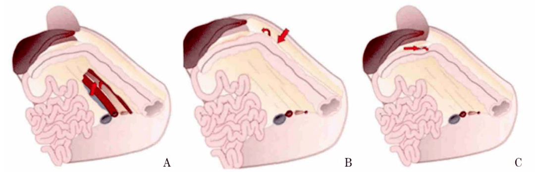 圖文詳解從解剖結構談遊離結腸脾曲的三大策略