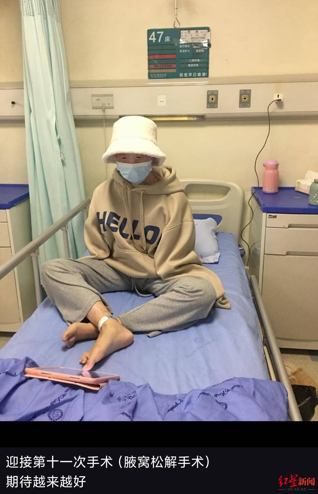 双手截肢全脸毁容,23岁烧伤女孩3年12次手术"重生":我还想变美_乔燕