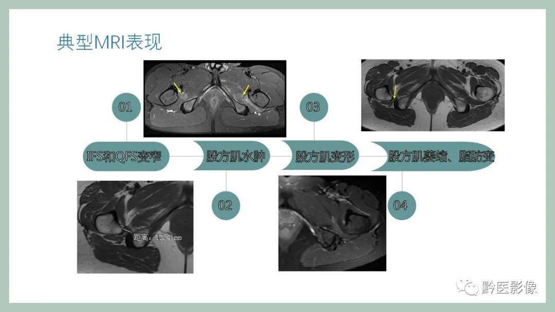 坐骨股骨撞击综合征（ischio-femoral impingement, ifi）