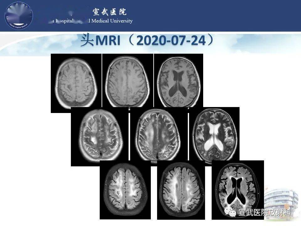 进行性多灶性白质脑病影像表现