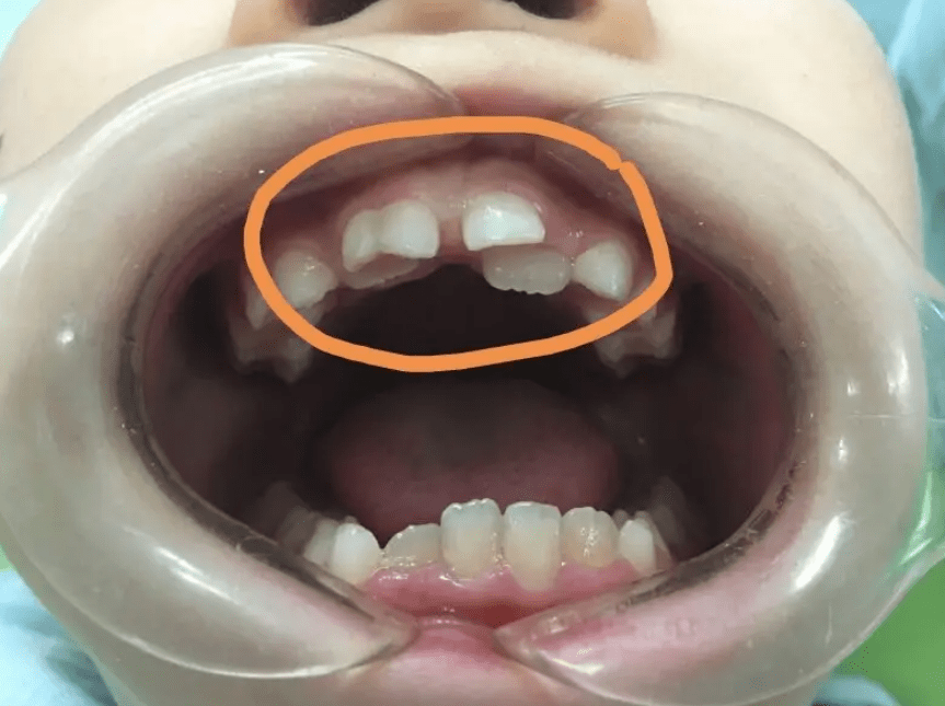 儿童牙齿咬合标准图片图片