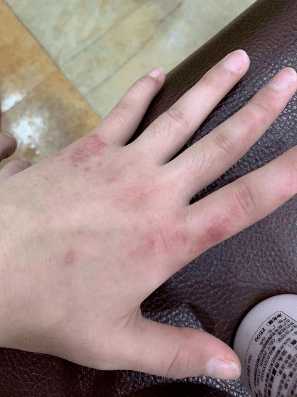 20岁大学生经常掉头发反复口腔溃疡竟然得了这种病