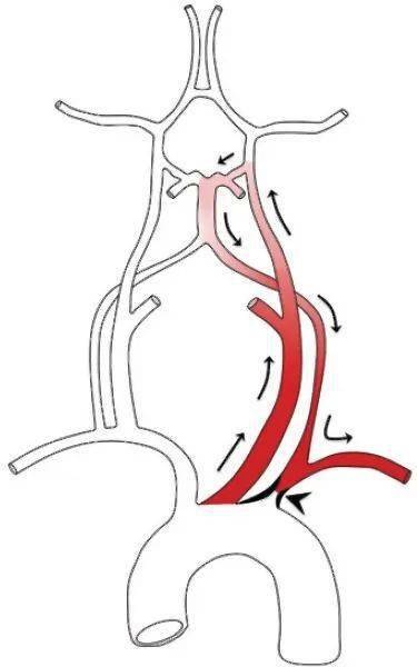 杏林微科普大动脉炎你了解么