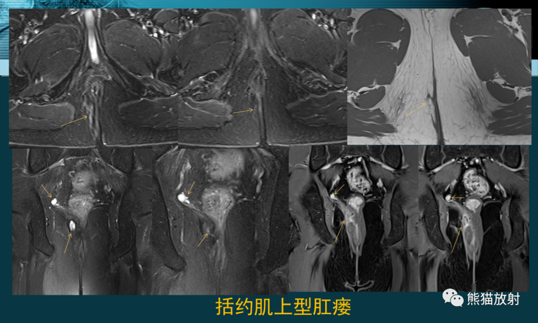 肛提肌mri图片