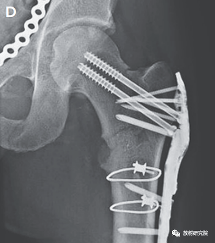 太神奇了新英格兰病例报道股骨头骨折坠入阴囊