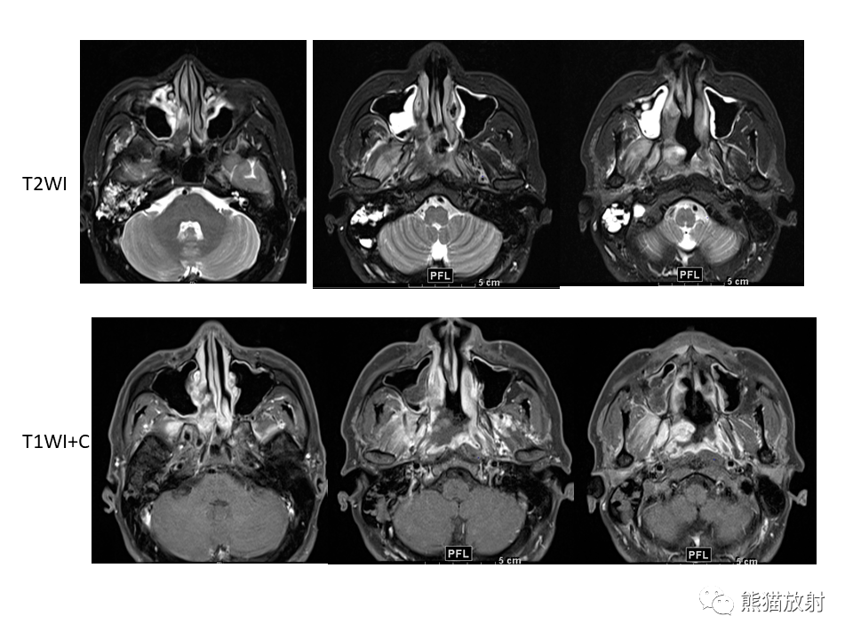 省立影像读片鼻腔鼻窦病变2204