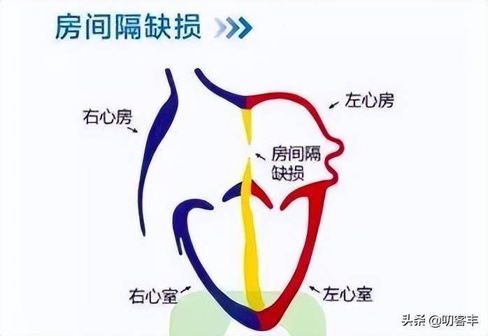 房间隔发育过程图片图片