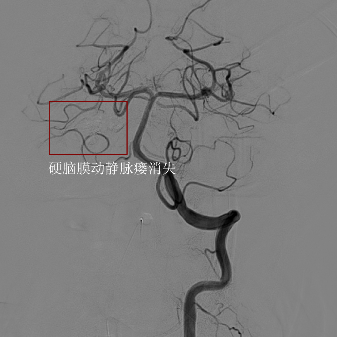 经脑膜垂体干途径栓塞小脑幕硬脑膜动静脉瘘