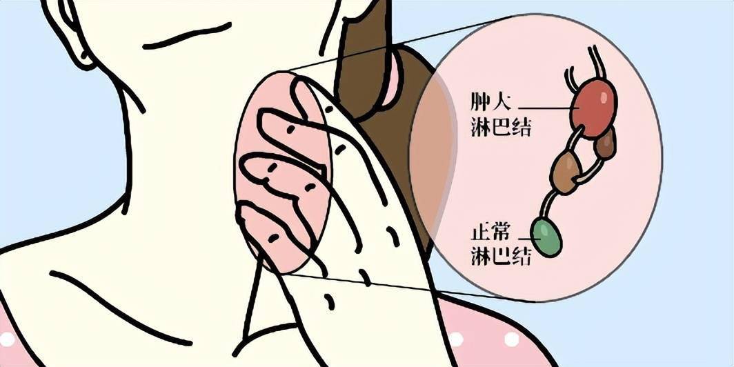 淋巴结转移 来自搜狐网