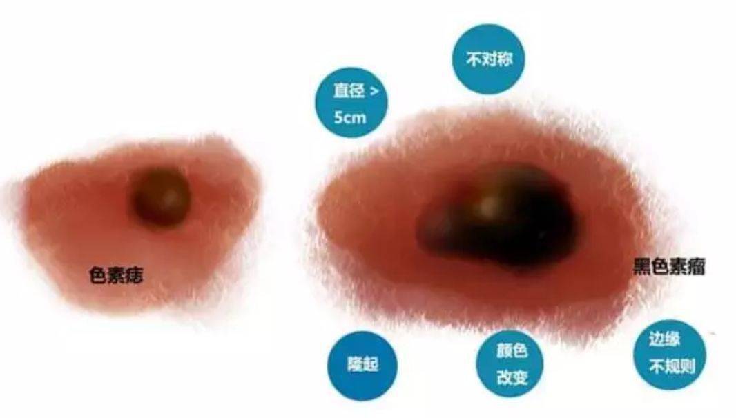 不对称性(asymmetry):普通痣两边是对称的,而黑色素瘤两边不对称.2.