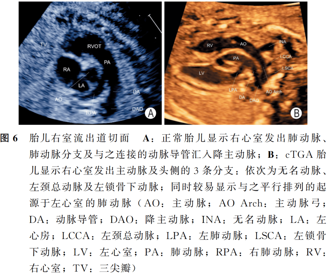 庆祝胎儿完全型大动脉转位中孕期超声检查中国专家共识2022版发布