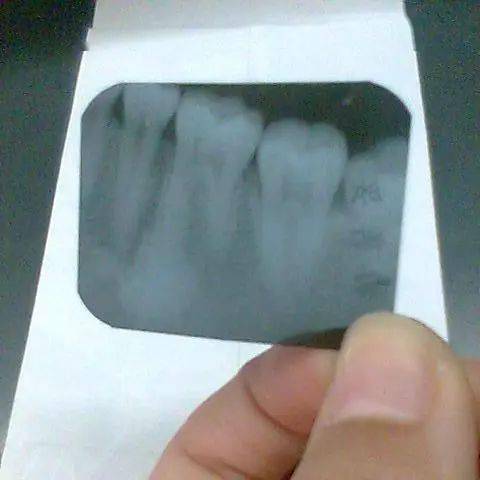 牙齿x光片报告单图片