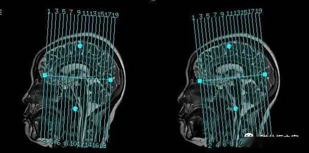 ct头颅扫描定位线图片图片