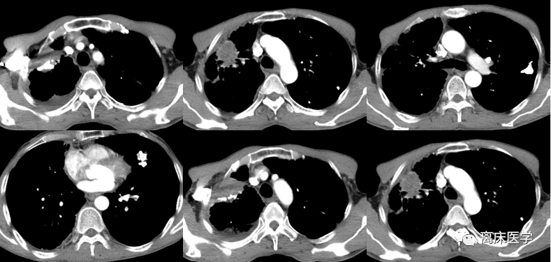 肺部阴影待查;2.胸腔积液.