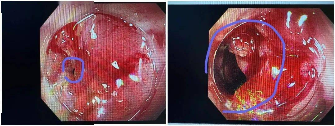这对母女中招的病,一旦患上无法治愈_克罗恩_阿姨_扩张