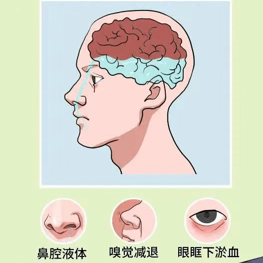 警惕清水鼻涕流不停竟被诊断为脑脊液鼻漏