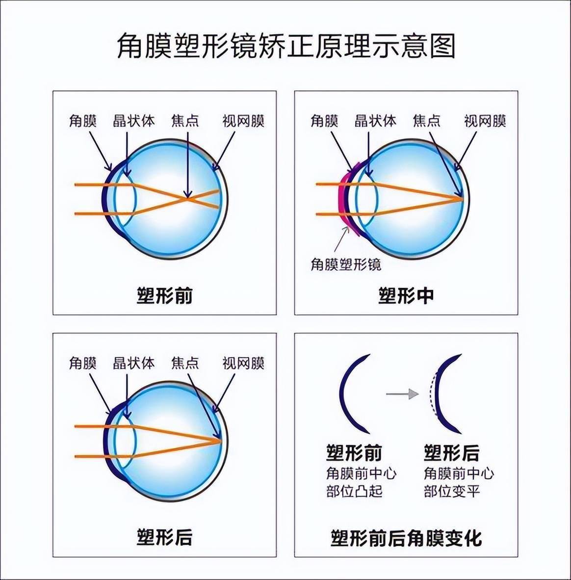 孩子小时候戴角膜塑形镜会影响成年后做近视手术吗