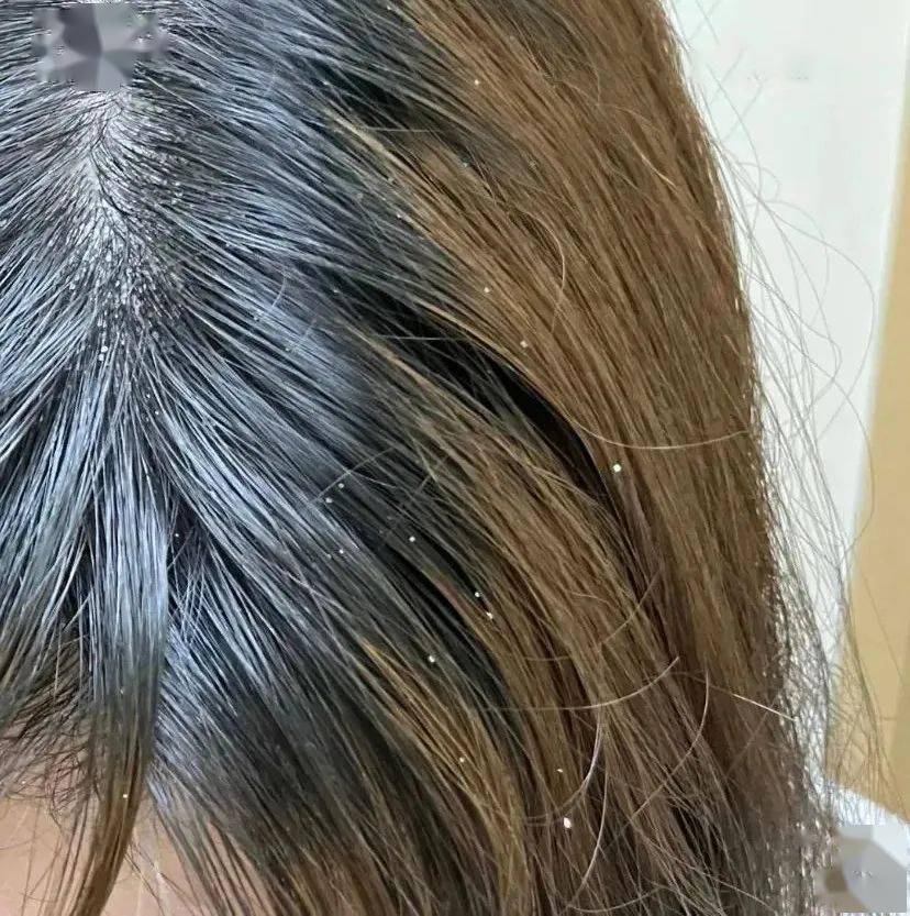 几乎夹遍了每一根发丝之前头屑密密麻麻到