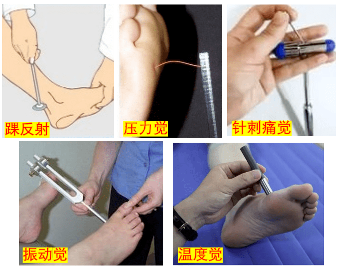 糖尿病神经病变检查图片