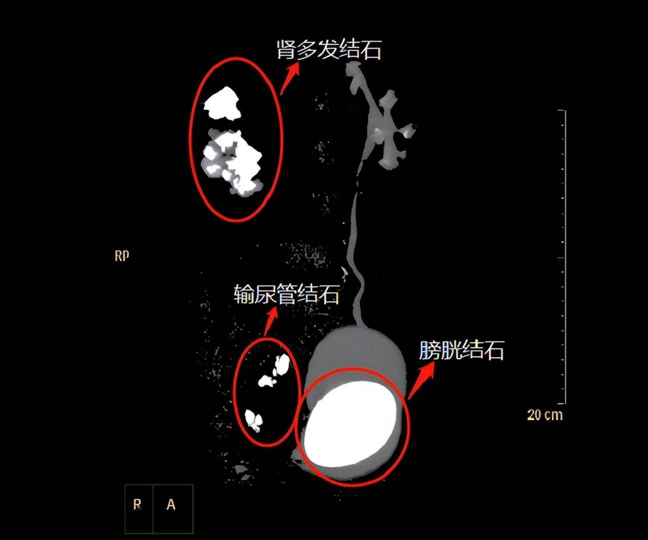 右側輸尿管也被結石填滿,膀胱內還有一顆鵝蛋大的結石,膀胱壁也有增厚