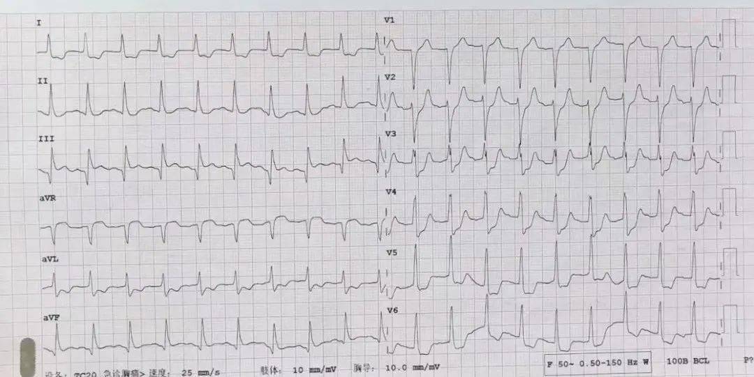 医救治急急急没有核酸报告重症医学科amp心血管内科合力挽救心肌梗死