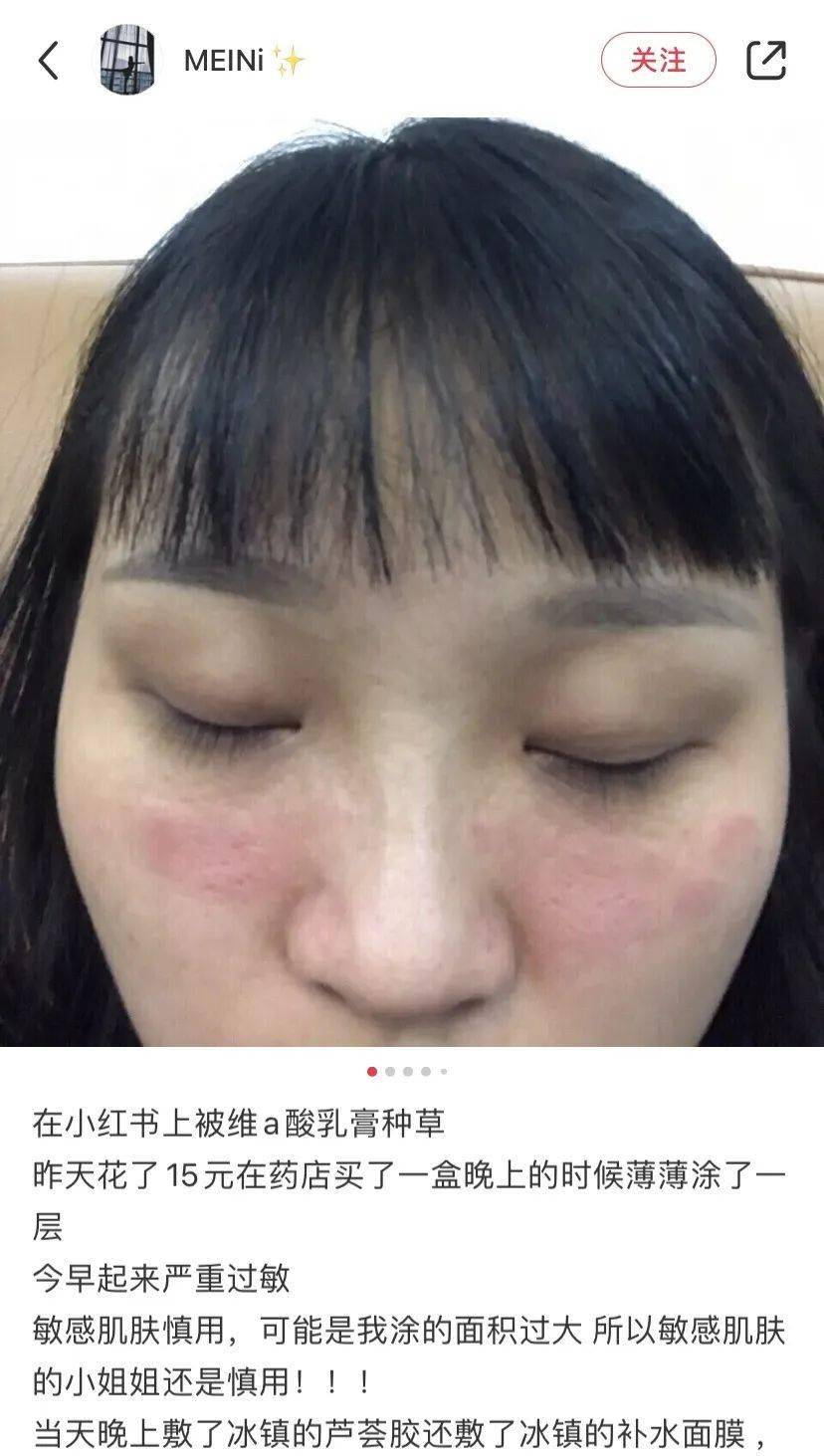 经常挤痘痘的女生都是这个下场
