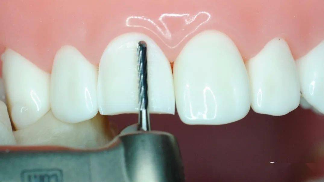 固美规范化瓷贴面预备车针瓷贴面预备的理想选择