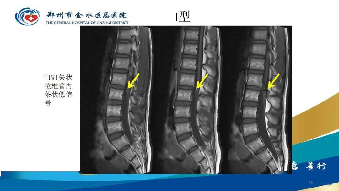 脊髓纵裂及相关疾病影像表现