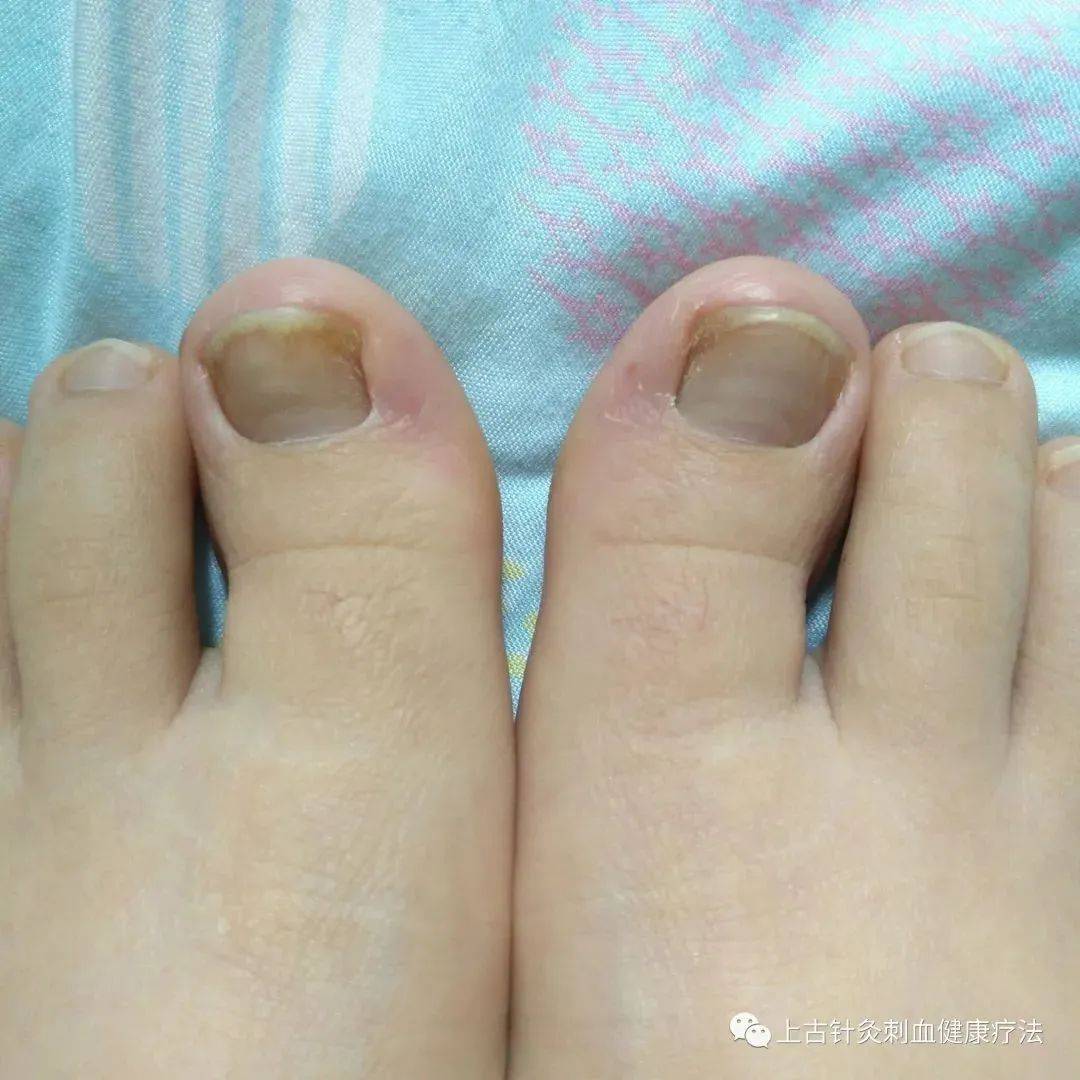 脚趾甲沟炎的症状图片-图库-五毛网