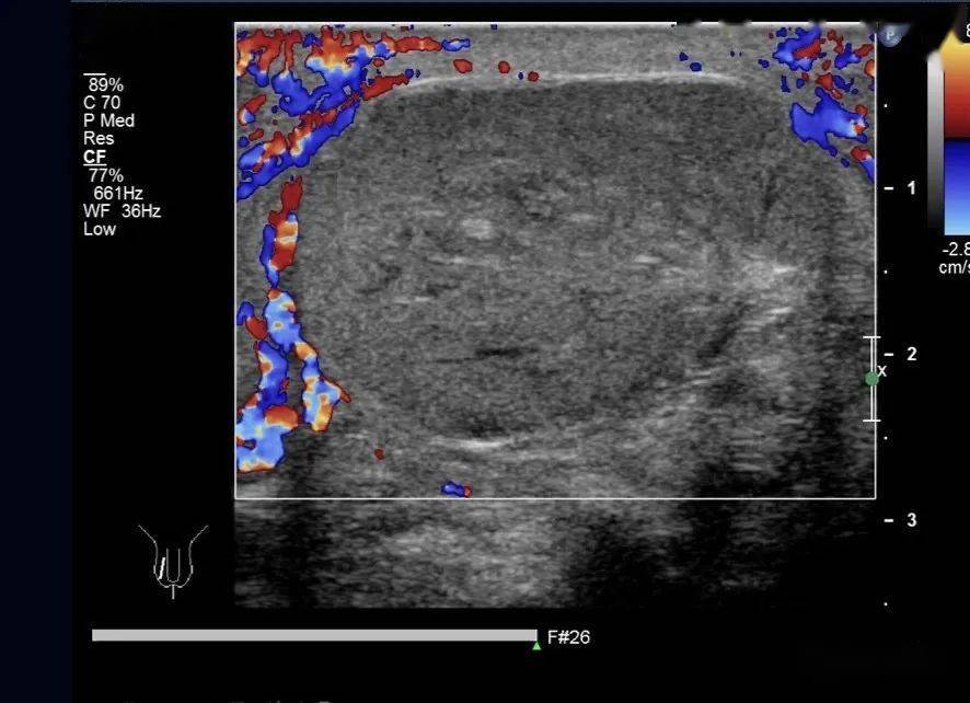 睾丸扭转彩超图片