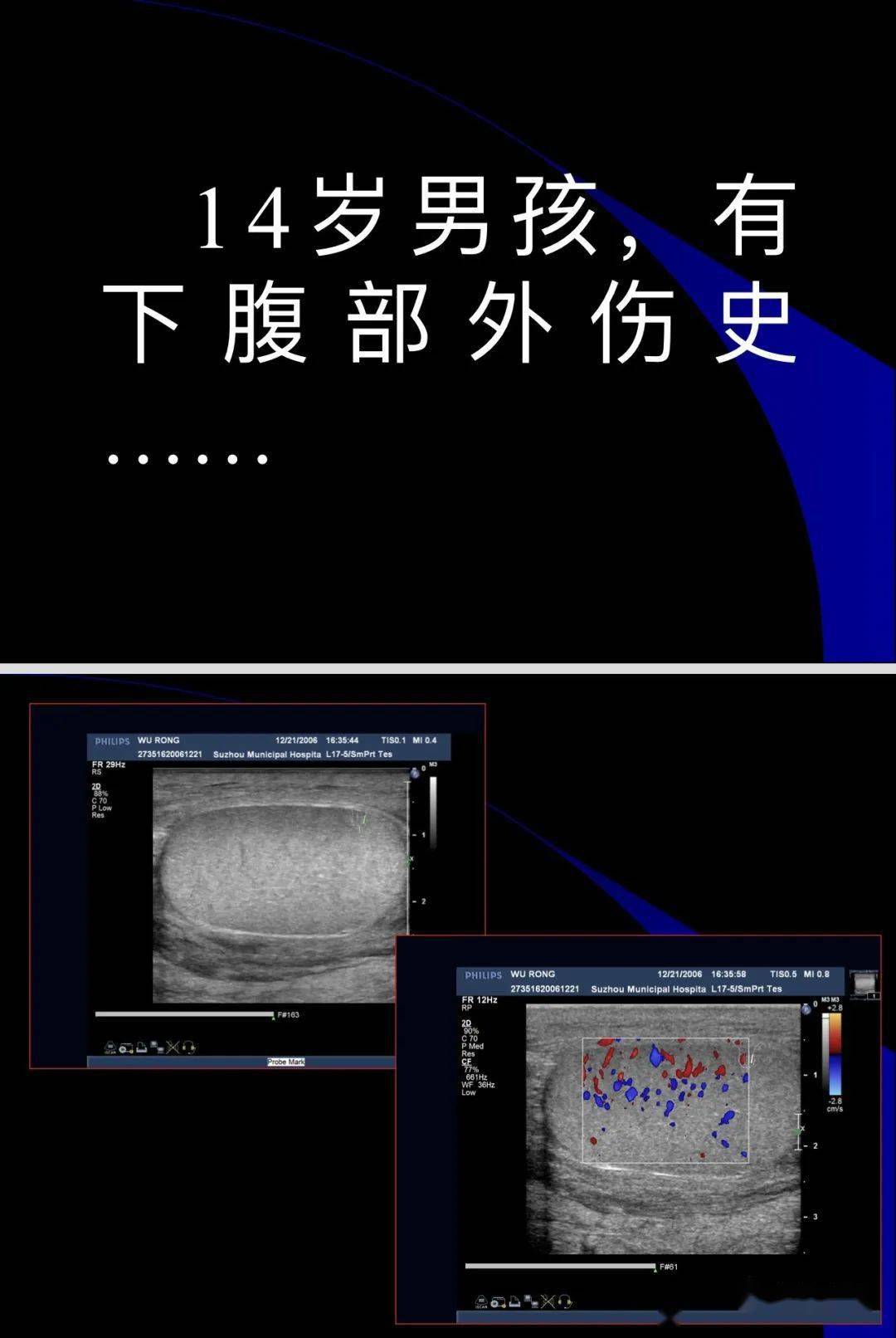 睾丸扭转症状图男孩图片