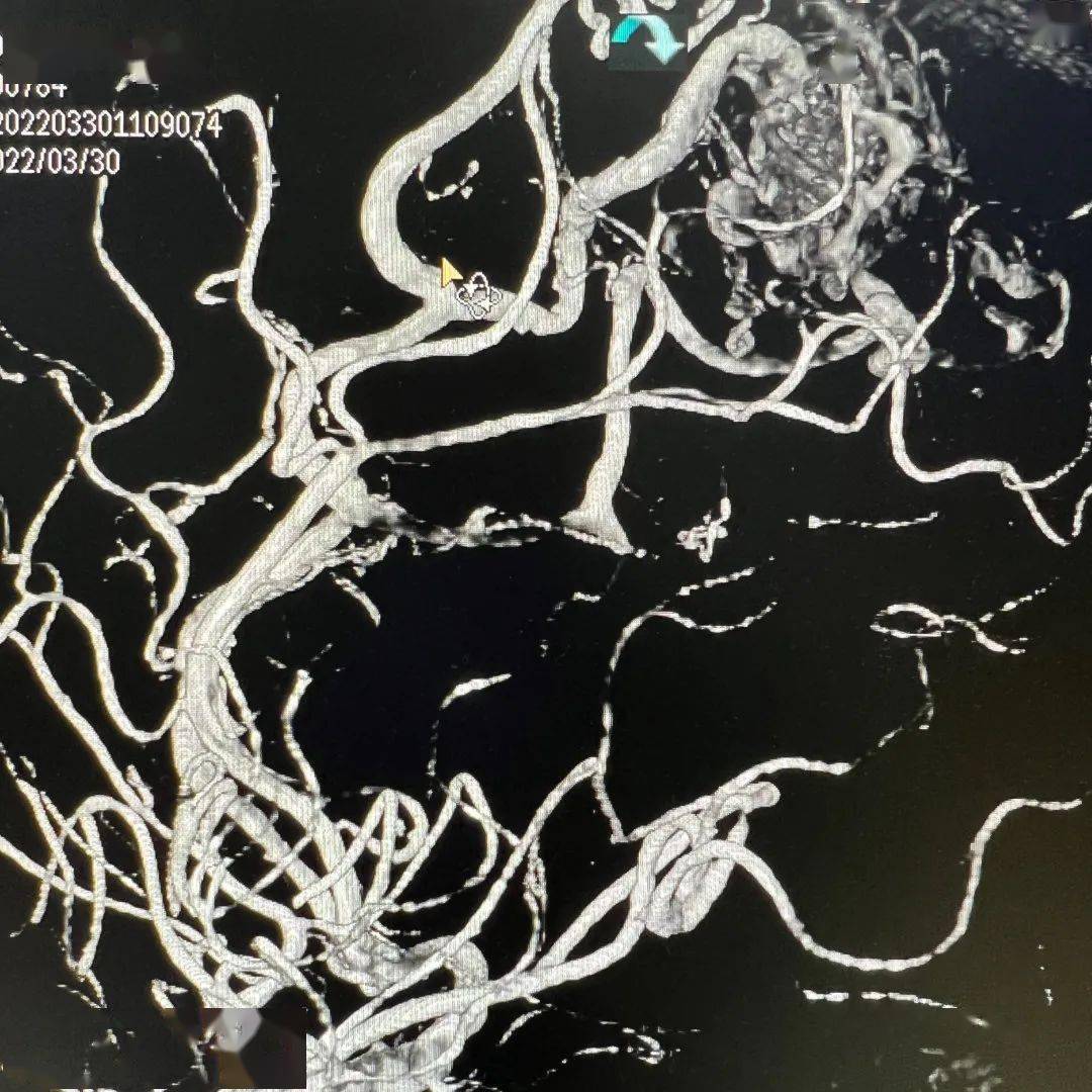 前循环入路栓塞颅内动静脉畸形两例