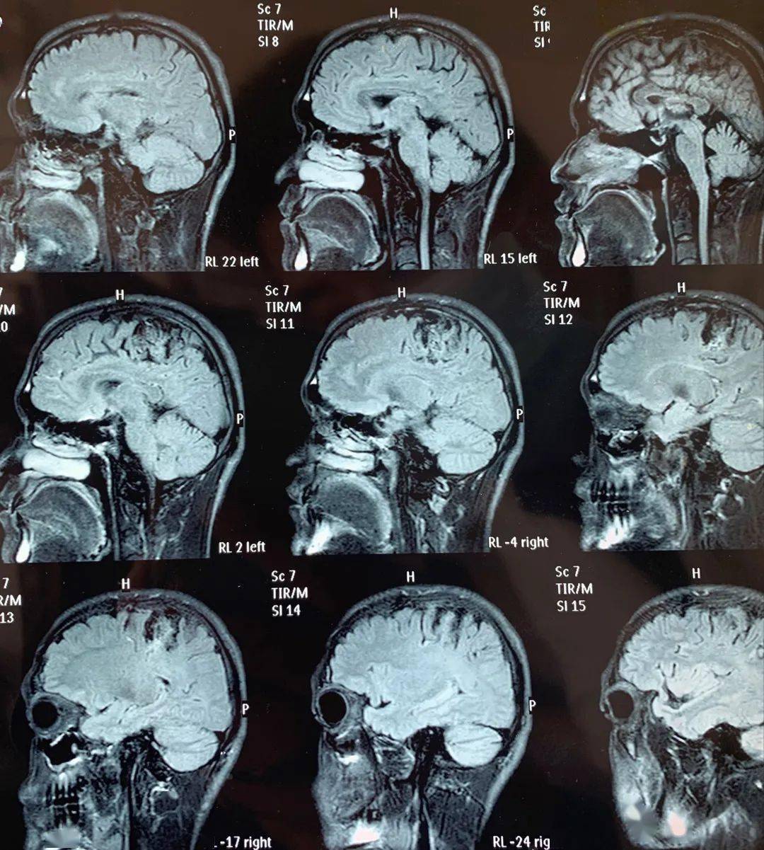 颅脑ct示,右侧额顶深部胼胝体压