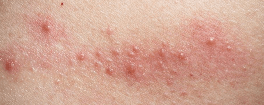 泛发性,可以发生于全身任一部位;容易反复发作;皮疹多形性,丘疹,水泡