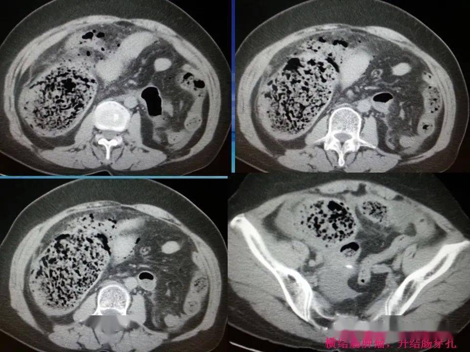 消化道穿孔CT图片