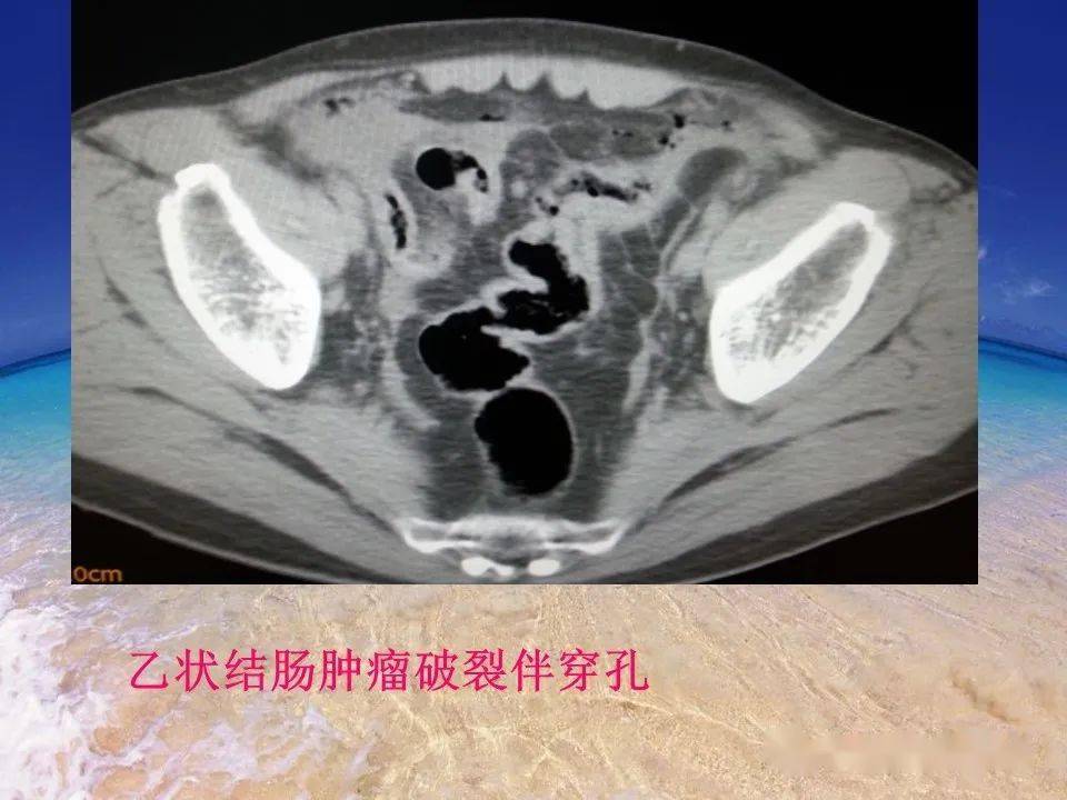 消化道穿孔ct影像大汇总看完印象深刻