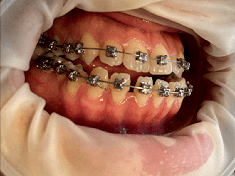 地包天患者不用上省医院了云县人民医院口腔科成功开展首例正颌手术