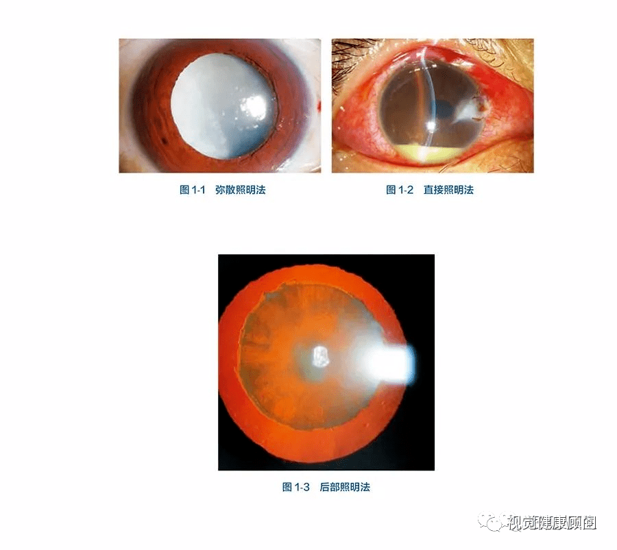 眼视光医生玩转眼部裂隙灯生物显微镜必不可少的