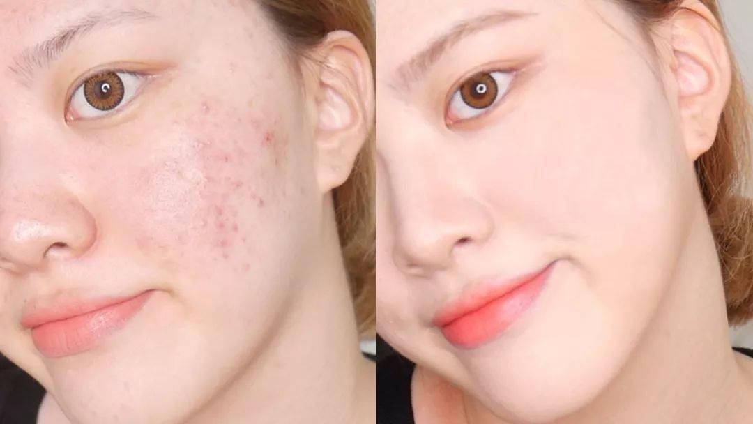 神奇万年痘印都没了日本变态祛痘膏24小时祛痘褪斑还不留印