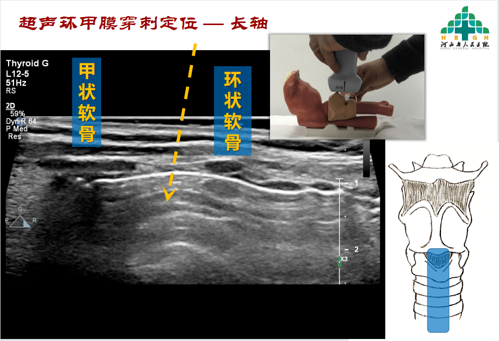 气道超声应用之环甲膜定位与穿刺