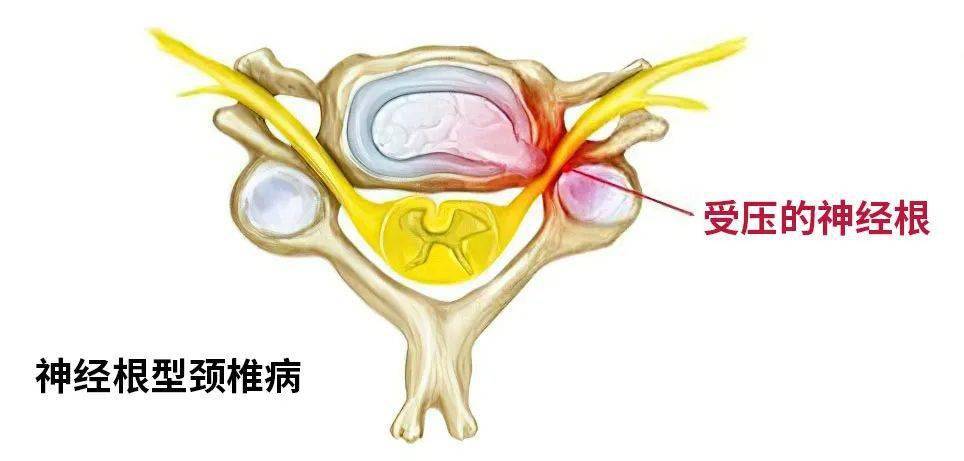 颈椎的脊髓发出的周围神经通过椎间孔离开中枢神经-脊髓后到颈肩部