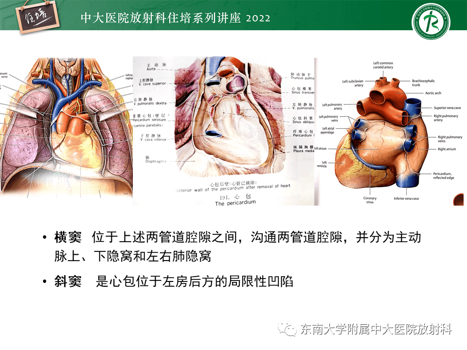 心包上隐窝解剖图片