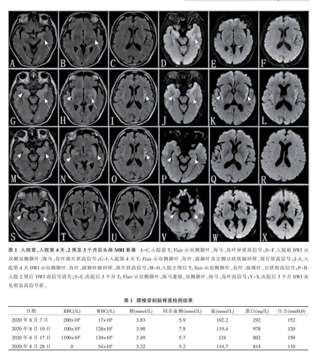 病例报告单纯疱疹病毒性脑炎致korsakoff综合征1例