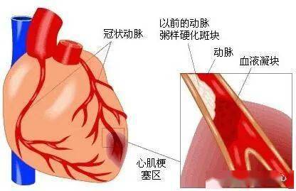 心脏供血不足的症状有哪些?你有吗?